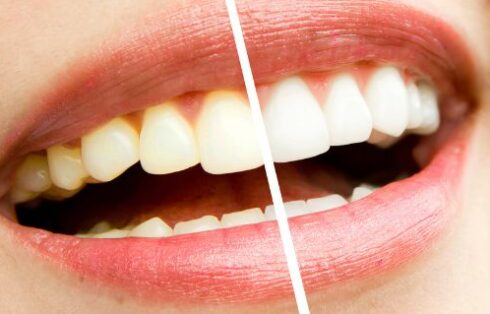 Como Fazer Clareador dental de Forma Fácil